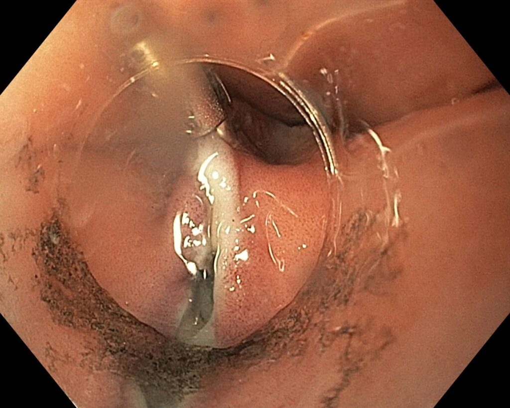 per rectum endoscopic myotomy-1