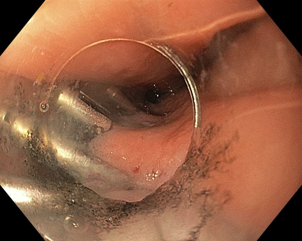 per rectum endoscopic myotomy-2