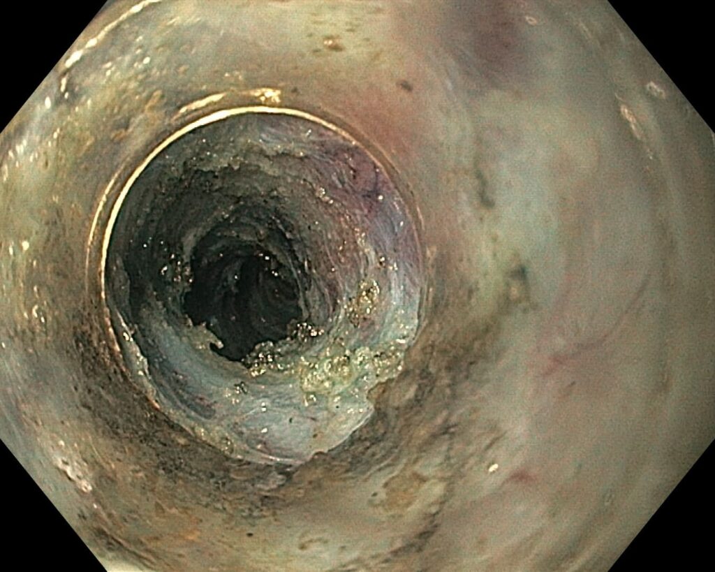 per rectum endoscopic myotomy-3