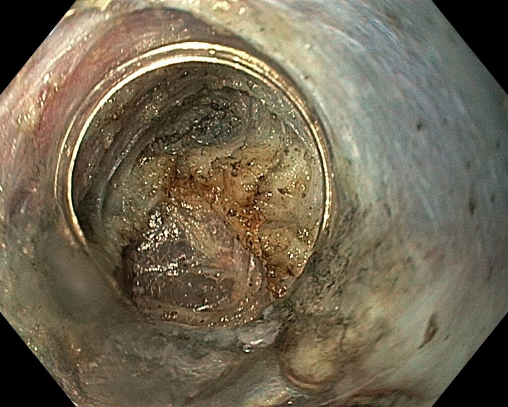 per rectum endoscopic myotomy-4