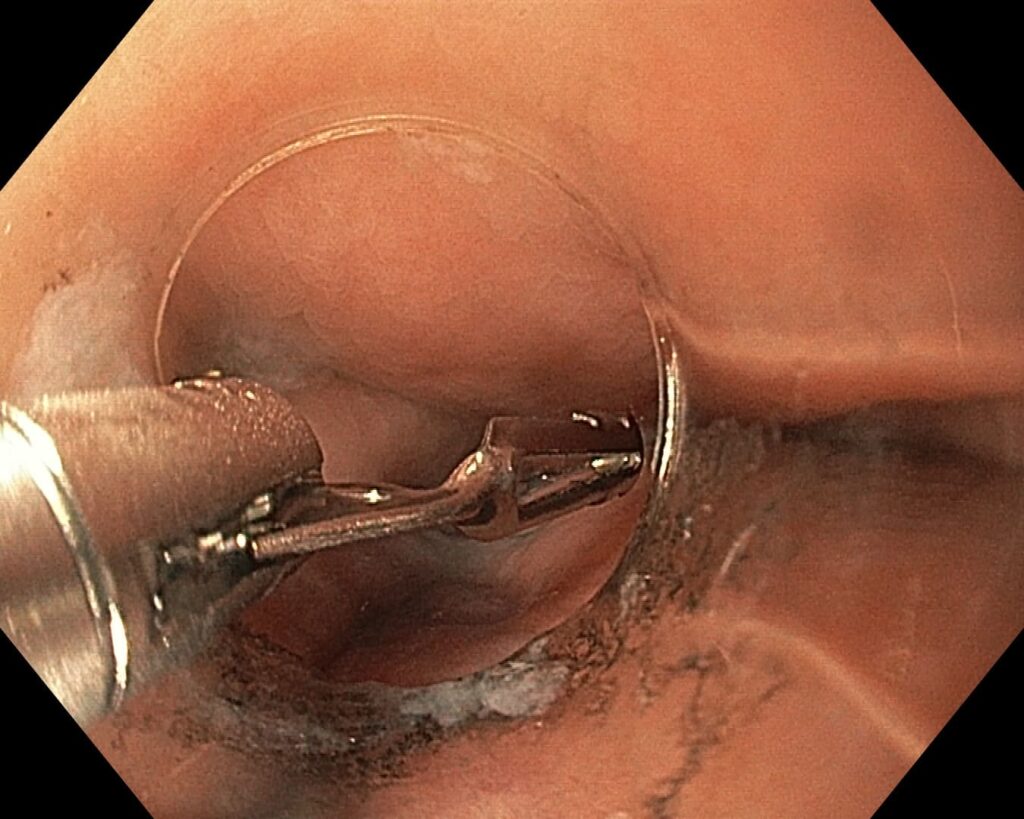 per rectum endoscopic myotomy-5