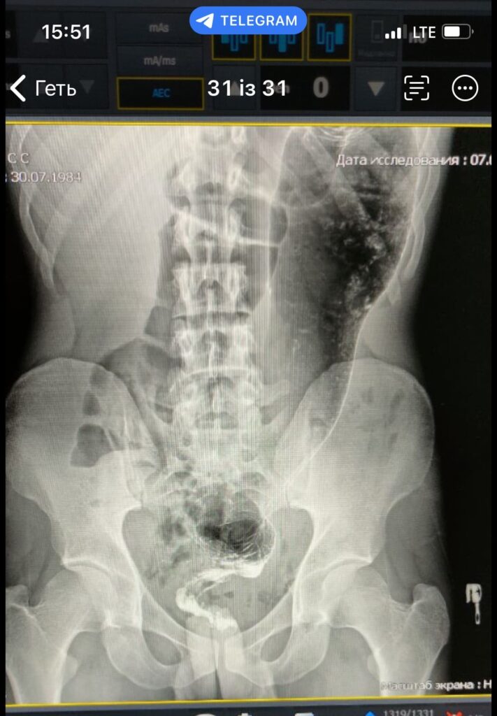 per rectum endoscopic myotomy-6