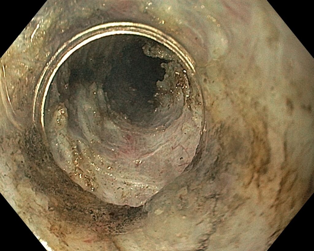 per rectum endoscopic myotomy-7