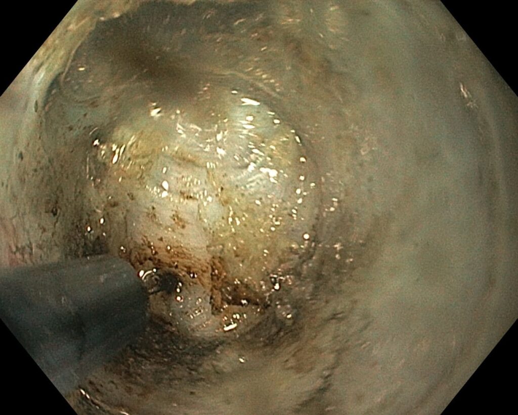 per rectum endoscopic myotomy-8